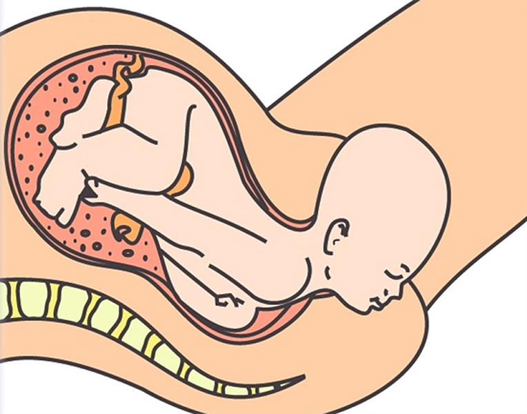 ambitie Schandelijk procedure EPI-NO birth preparation, pregnancy, episiotomy, pelvic floor training,  EPINO | Birth- Preparation