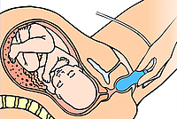 Geburtsvorbereitung mit EPI-NO